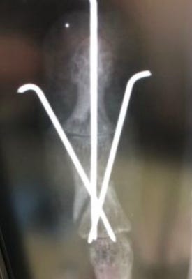 三歳児 骨折 手術で入れたむき出しの針金を抜く日 ハウスドゥ 住宅情報モール 小倉南店 北九州市小倉南区の地域密着型 不動産情報サイト Sp